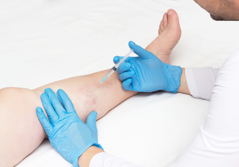 sclerotherapy for varicose veins in pcmc, pune