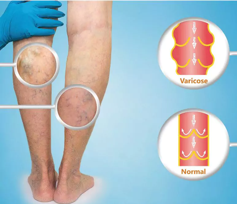 varicose vein Treatment in Pune